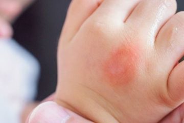 Punture di insetti sui neonati: effetti, prevenzione e rimedi