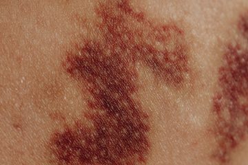 l’immagine rappresenta un rush cutaneo da probabile orticaria