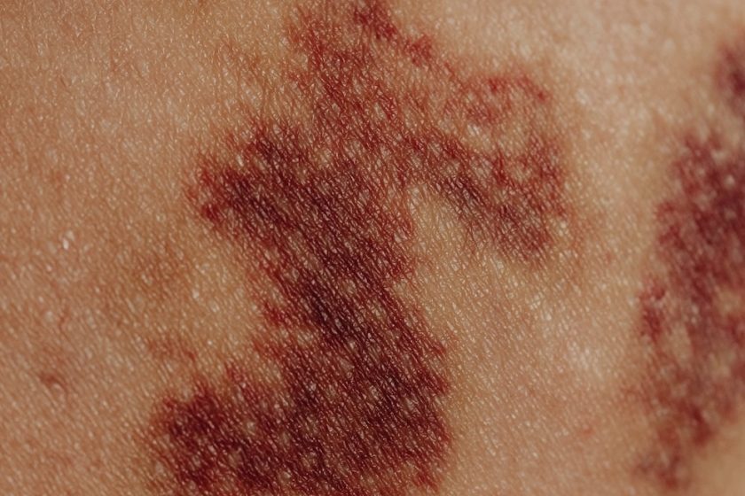 l’immagine rappresenta un rush cutaneo da probabile orticaria