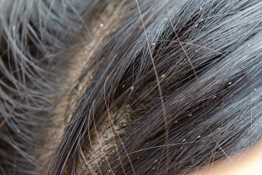 Dettaglio di lendini attaccate ai capelli del bambino vicino alla radice